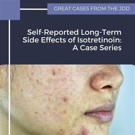 Isotretinoin Uses, Side Effects & Warnings .
